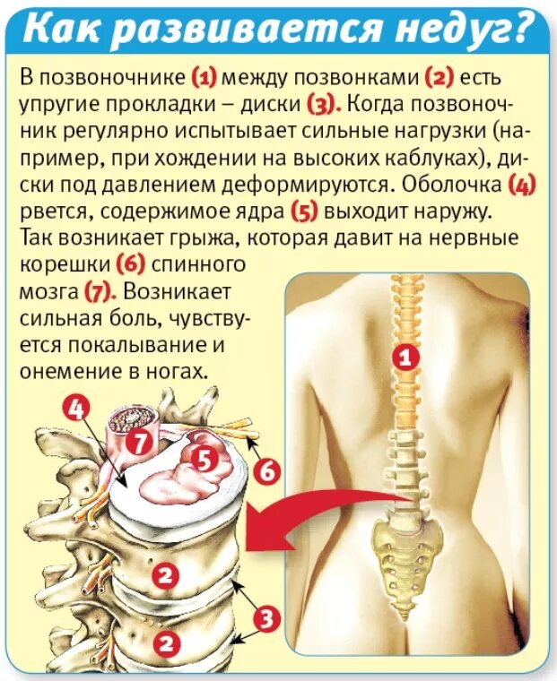 Грыжа позвоночника. Психосоматика грыжи поясничного отдела позвоночника. Грыжа на спине на позвоночнике. Болит позвоночник.