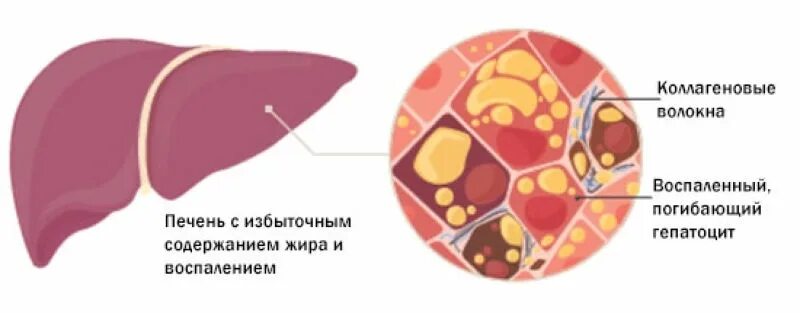 Жировое увеличение печени. Неалкогольный жировой гепатоз печени. Неалкогольная жировая дистрофия печени. Неалкогольный цирроз печени.