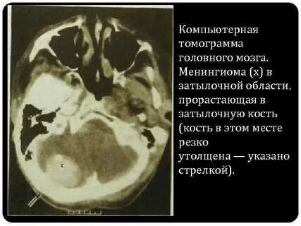 Опухоль головного черепа