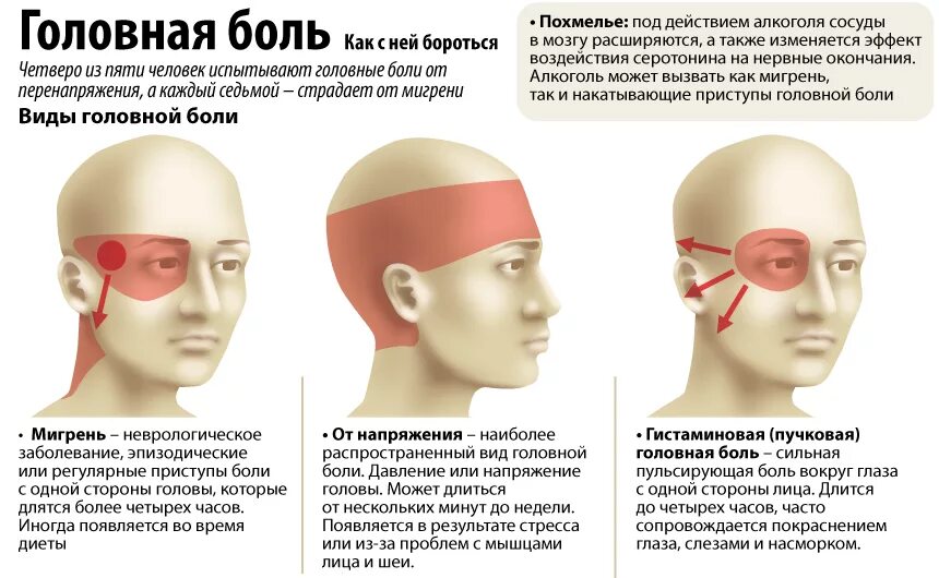 Болит голова к какому врачу идти. Виды головной боли. Локализация глазной боли. Боль в висках головы. Мигрень и головная боль напряжения.