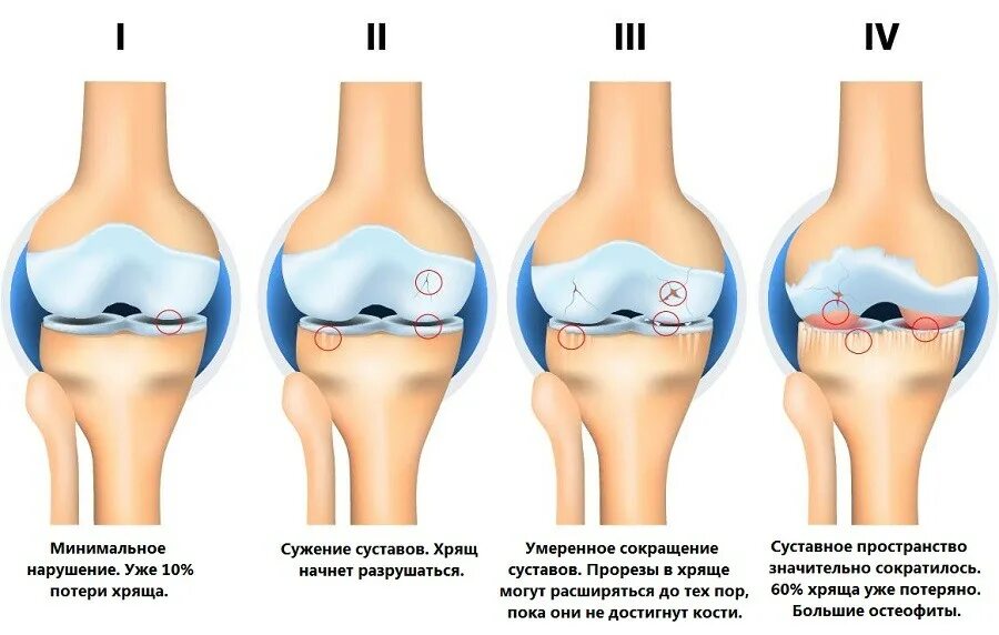 Гонартроз какой сустав. Остеоартроз коленного сустава степени. деформирующий остеоартроз классификация. разрушение синовиальной хрящевой оболочки. субхондральное утолщение хрящевой ткани суставных поверхностей.