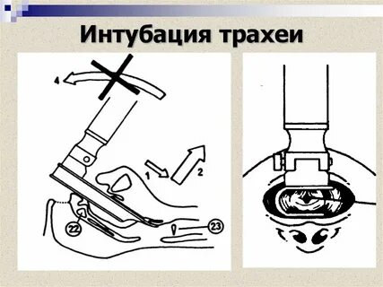 Интубация трахеи дети