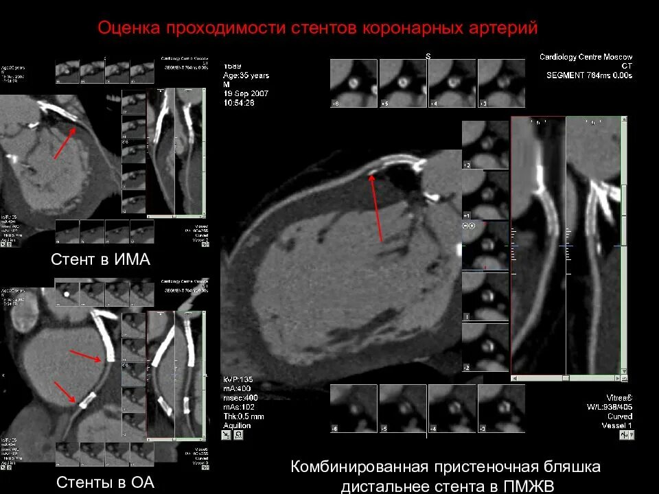 Стенты мрт. Стент коронарной артерии кт. стенты коронарных артерий на кт. пмжв в кардиологии.