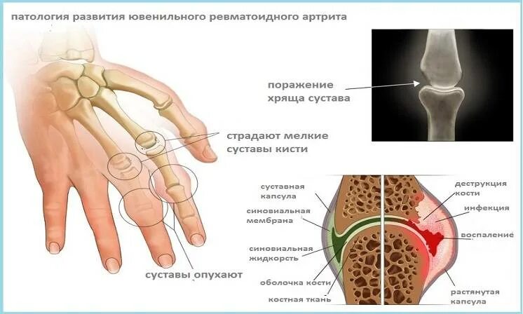 Ревматоидного артрита у детей клинические. Идиопатический ревматоидный артрит. Детский ювенильный ревматоидный артрит. Системный ювенильный ревматоидный артрит. Ювенильный реактивный артрит.