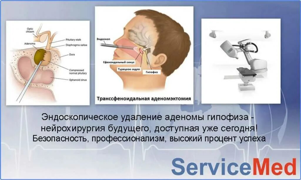 Симптомы гипофиз у мужчин. Эндоселлярная аденома гипофиза. Аденома гипофиза операция.