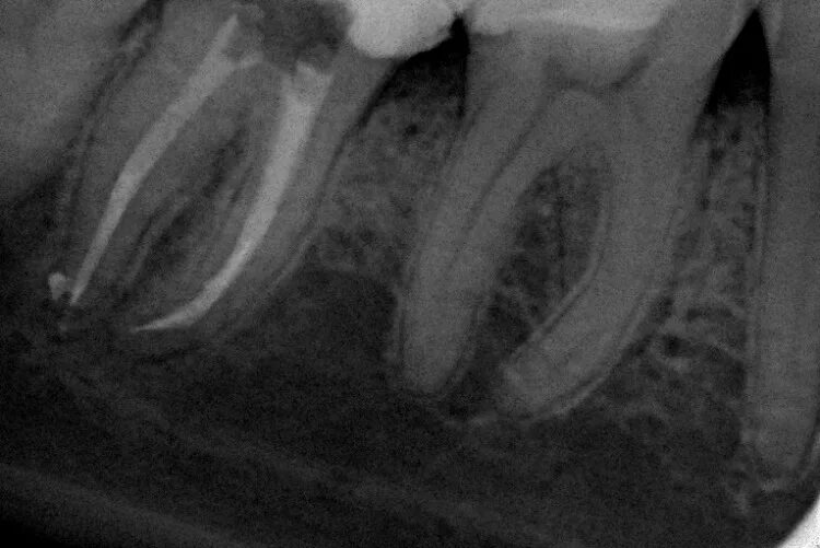 Пульпит корневого канала. Корневые каналы зубов рентген.