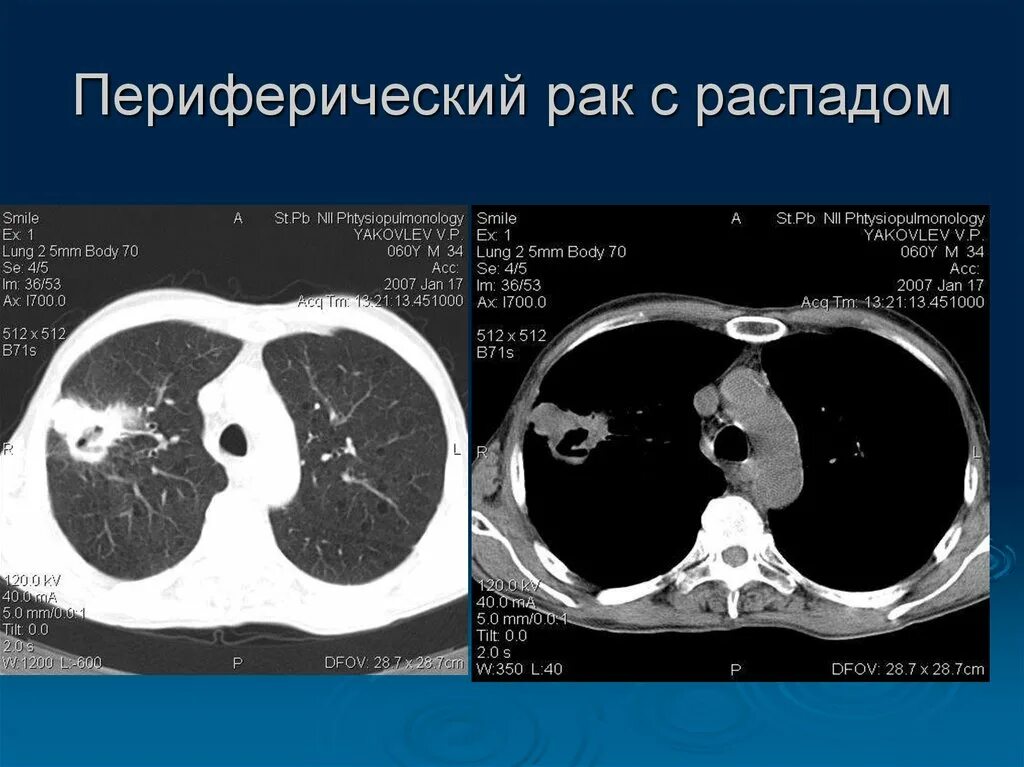 Опухоль легкого с распадом.