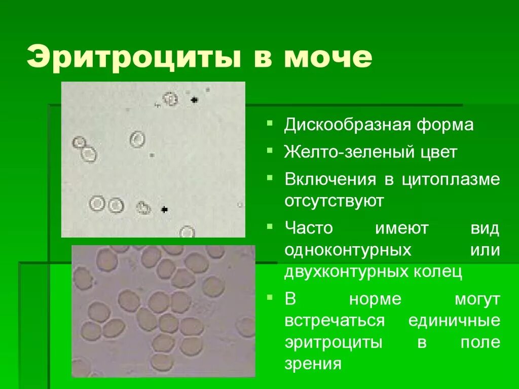 Эритроциты повышены у ребенка в моче причины. Эритроциты в моче. Выщелоченные эритроциты в моче. Измененные эритроциты в моче. Неизмененные эритроциты в моче.