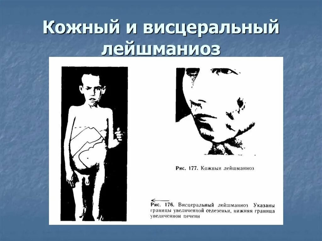 Висцеральный лейшманиоз. Кожный лейшманиоз клинические. висцеральный лейшманиоз (кала-азар). клинические проявления висцерального лейшманиоза. лейшманиоз кожные проявления.