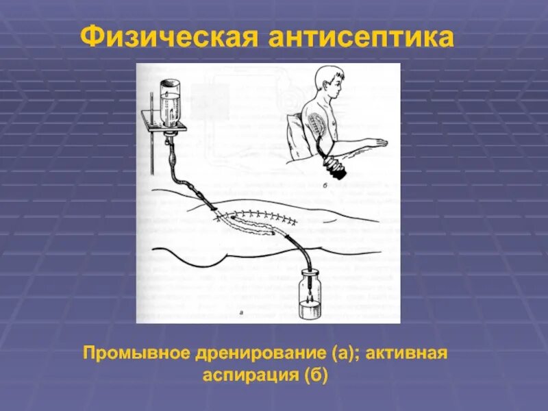 Механическая антисептика. Физический метод антисептики. Физическая антисептика дренирование. Аспирационно промывное дренирование. Антисептика дренирование РАН.