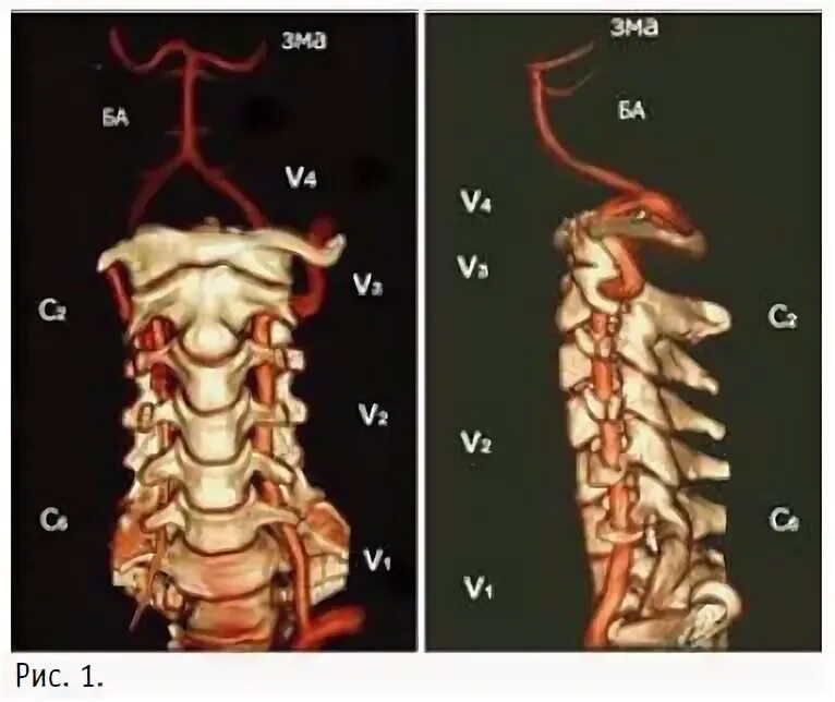 Сегмент v1 позвоночной артерии. Сегменты v3 v4 позвоночной артерии. V4 сегмент позвоночной артерии. V3-v4 позвоночная артерия.