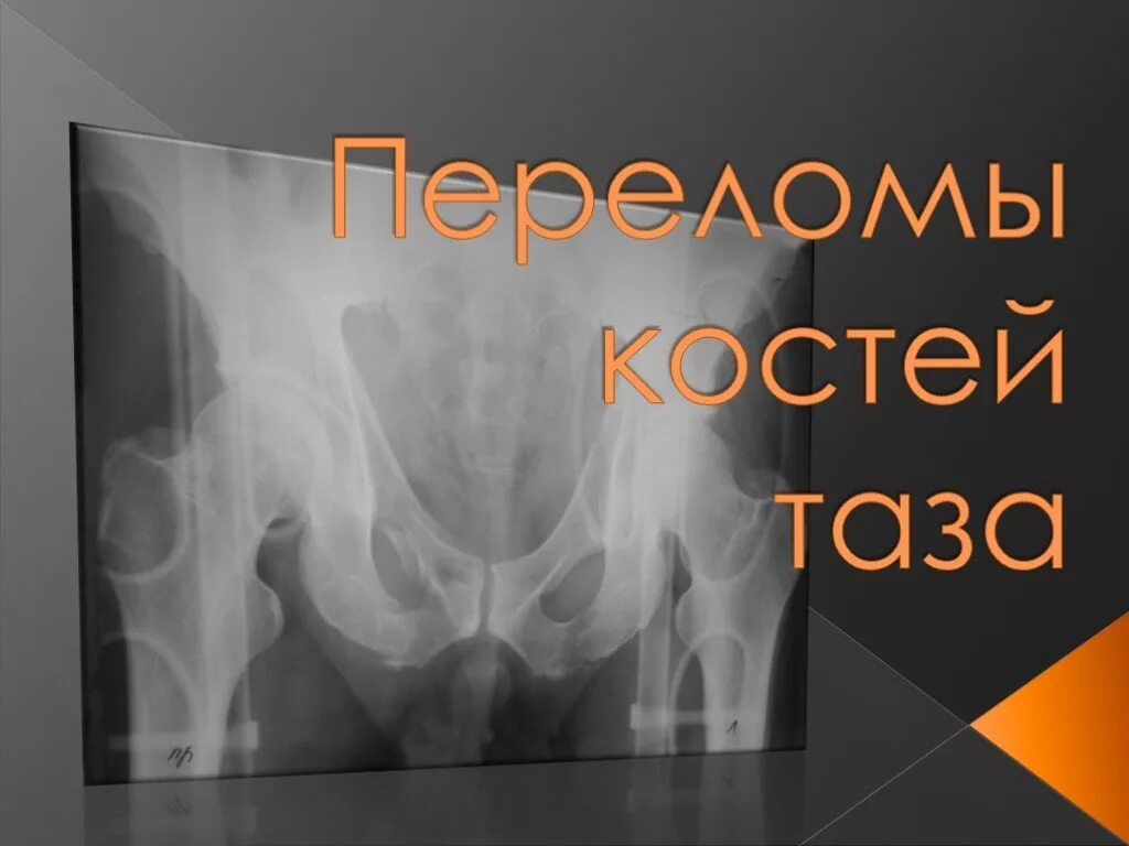 Перелом костей таза код по мкб 10. Травмы таза презентация. Перелом таза презентация. Переломы таза травматология. Переломы костей таза презентация.