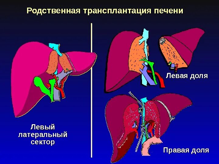 Трансплантация левой доли печени. Техника ортотопической трансплантации печени. Трансплантация печени схема. Трансплантация печени презентация.