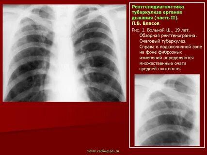 Диагностика туберкулеза рентген