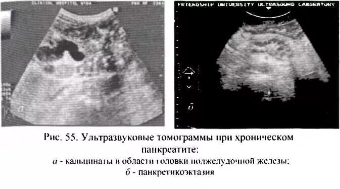 Панкреатит головка. УЗИ поджелудочной железы хронический панкреатит. УЗИ картина хронического панкреатита. Сонография поджелудочной железы. Хронический панкреатит УЗИ.