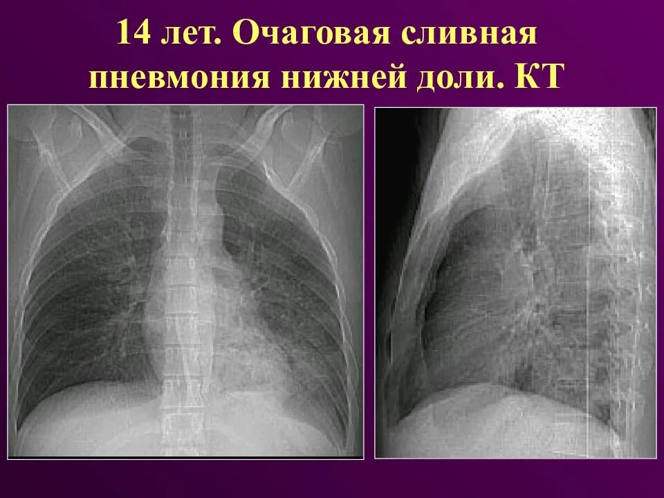 Стрептококковая бронхопневмония. Крупозная пневмония и бронхопневмония. Первичный туберкулезный комплекс рентген. Очаг в легких у ребенка. Очаговая пневмония бронхопневмония.
