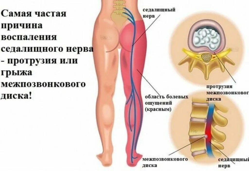 Болит защемление нерва