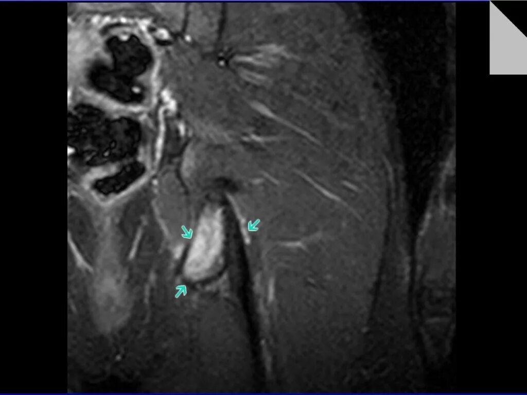 Остеофиброма бедренной кости. Сумки тазобедренного сустава мрт. Сумки тазобедренного сустава мрт. Суставная сумка тазобедренного сустава анатомия. Подвздошно-гребешковый бурсит тазобедренного сустава мрт.