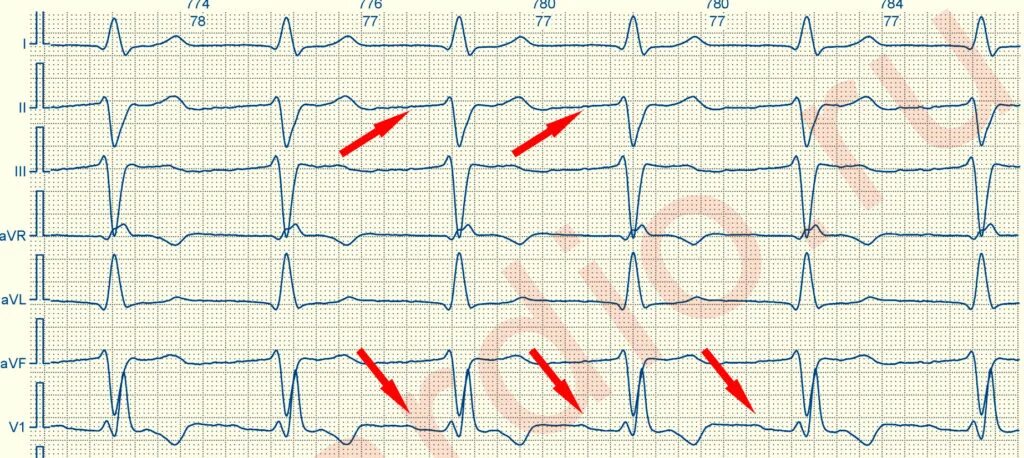 Блокада qrs. Блокада левой передней ветви пучка Гиса на ЭКГ. Блокада ПНПГ на ЭКГ. Блокада передней верхней ветви ЛНПГ на ЭКГ. Преходящая блокада ножки пучка Гиса ЭКГ.