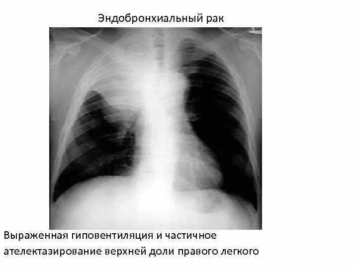 Лучевая при раке легких