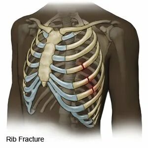 Broken ribs