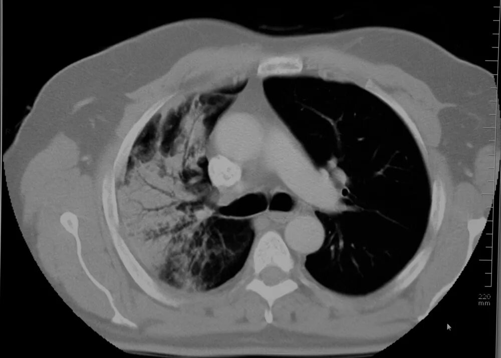 Эозинофильная пневмония кт. Пневмоцистная пневмония на кт. Кт рентген. Легочное кровоизлияние кт.