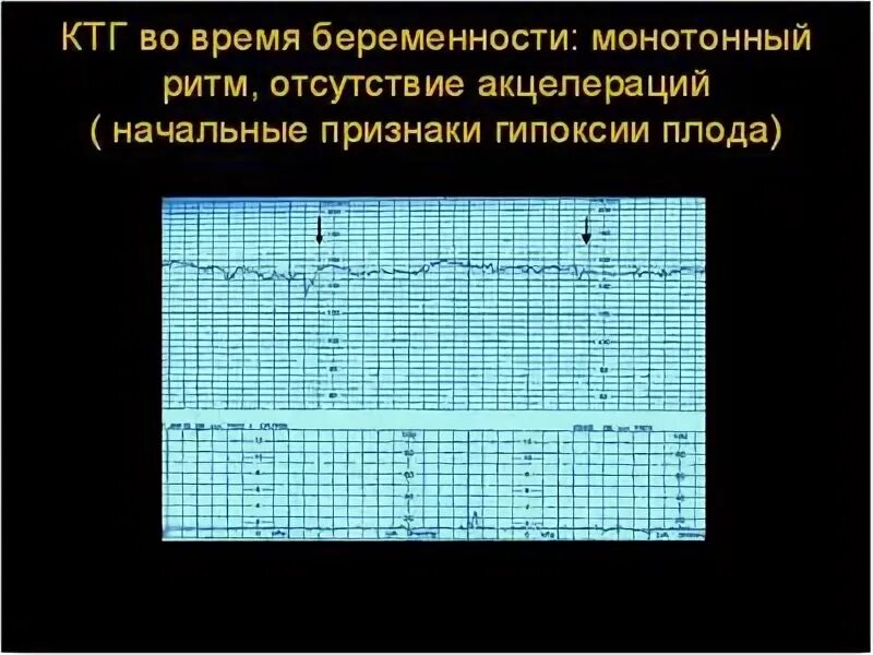 Подозрительное ктг. Патологический тип ктг плода. синусоидальный ритм ктг. гипоксия ктг показатели.