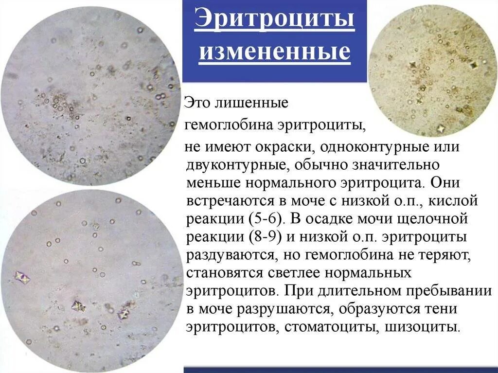 Почему у детей эритроциты в моче. Измененные и неизмененные эритроциты в моче микроскопия. измененные (дисморфные) эритроциты в моче. измененные и неизмененные эритроциты в микроскопии мочи. выщелоченные эритроциты в моче механизм образования.