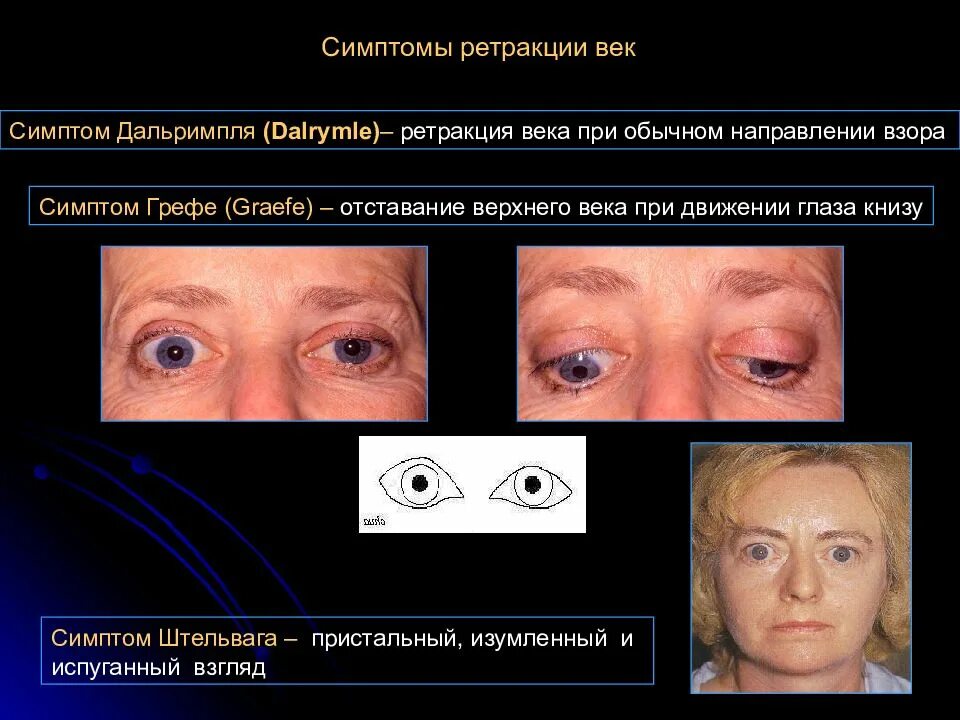 Экзофтальм наблюдается при. Симптом герые. Симптом грёффе.