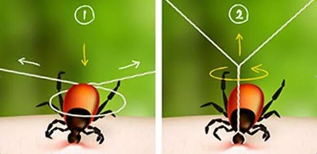 Удалить клеща в домашних условиях самостоятельно. Извлечение клеща с помощью нитки. Как удалить клеща с помощью нитки. Как достать клеща у человека ниткой. Вытащить клеща с помощью нитки.