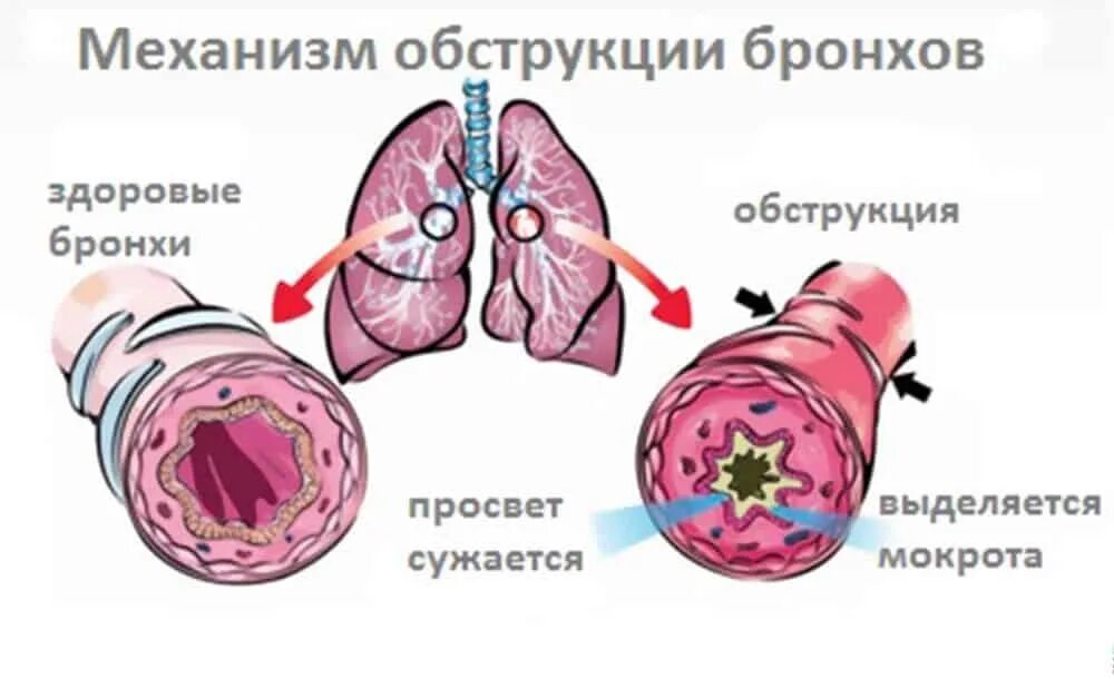 Бронхит отзывы взрослых. Хронический обструктивный бронхит синдромы. хронический бронхит бронхообструктивный синдром. патогенез обструктивного бронхита. острый бронхит с обструктивным синдромом у детей.