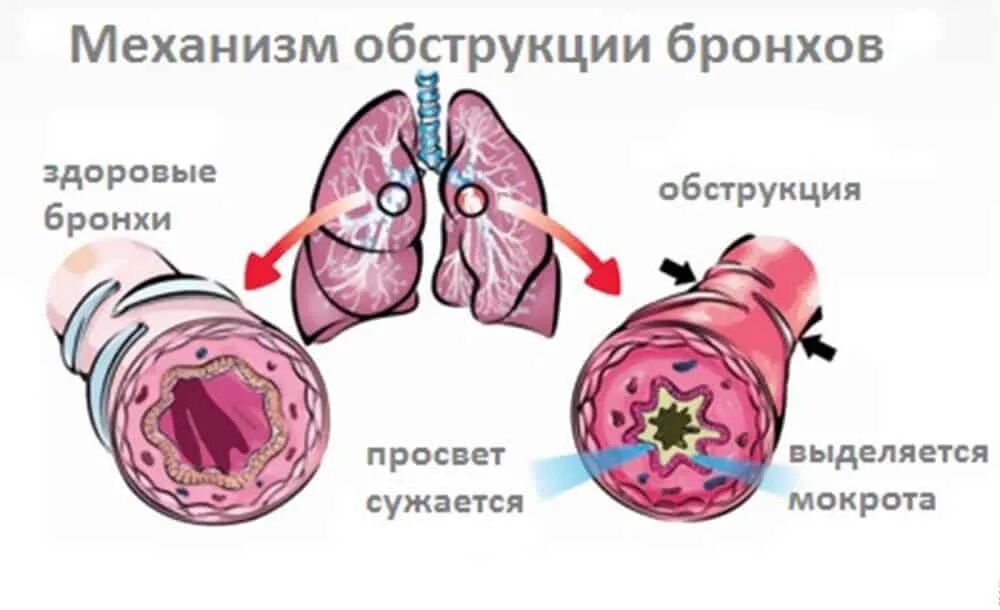 Острый бронхит с синдромом бронхиальной обструкции. Синдром бронхиальной обструкции. Бронхообструктивный синдром механизм. Острый бронхит с обструктивным синдромом. У ребенка легкий бронхит