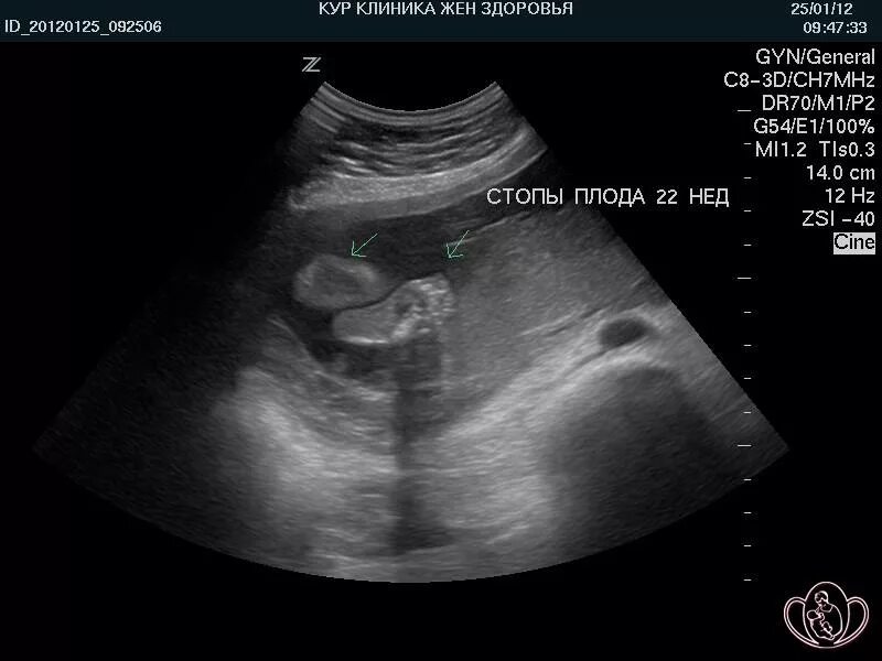 УЗИ 20 недель беременности. 21-22 Неделя беременности.