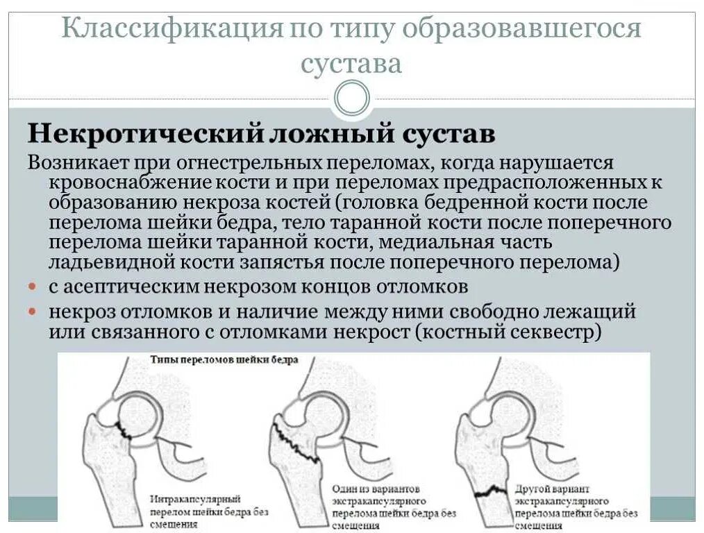Перелом шейки бедра симптомы как определить. Классификация переломов шейки бедренной кости. ложный тазобедренный сустав. ложный сустав шейки бедра классификация. классификация при переломе шейки бедра.