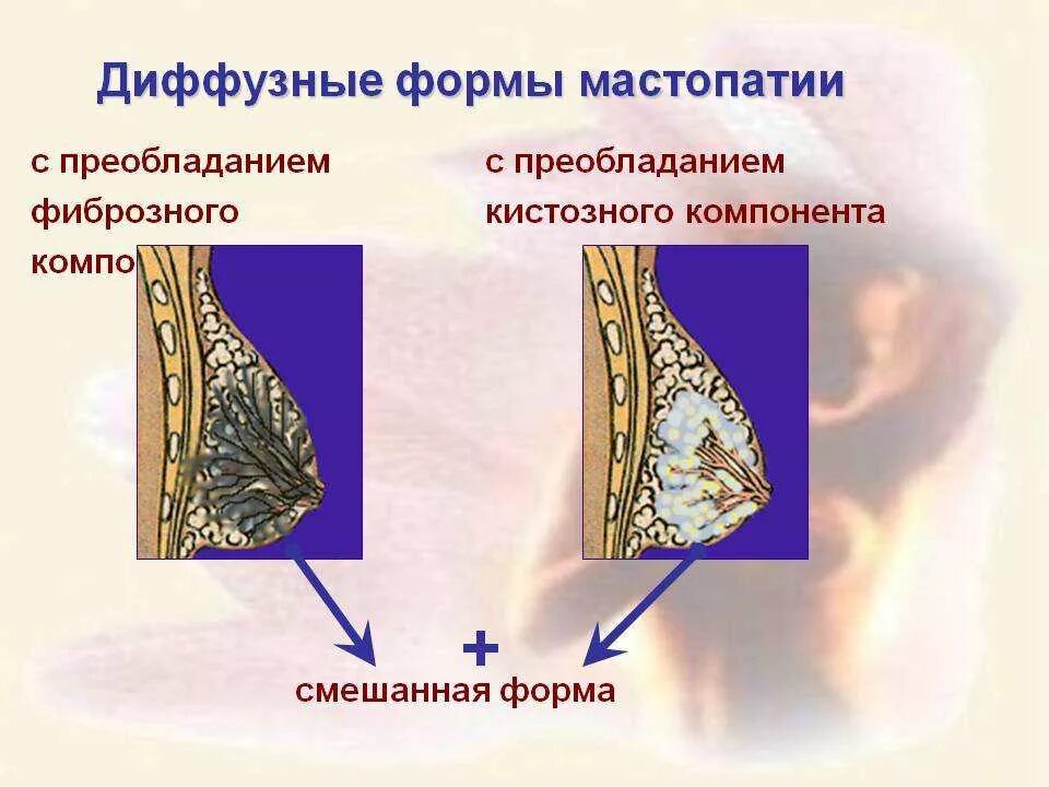 Фиброзно-кистозная мастопатия диффузная Узловая. Фиброзная мастопатия молочной железы что это. Диффузная, диффузно-Узловая, фиброзно- кистозная, Узловая мастопатия. Диффузная кистозная мастопатия. Лечение диффузно кистозной