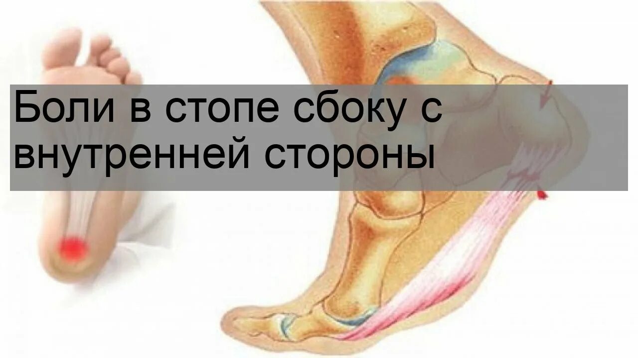 Болит пятка сбоку. Боль в своде стопы с внутренней. болит свод стопы с внутренней стороны. болит стопа сбоку с внутренней стороны.