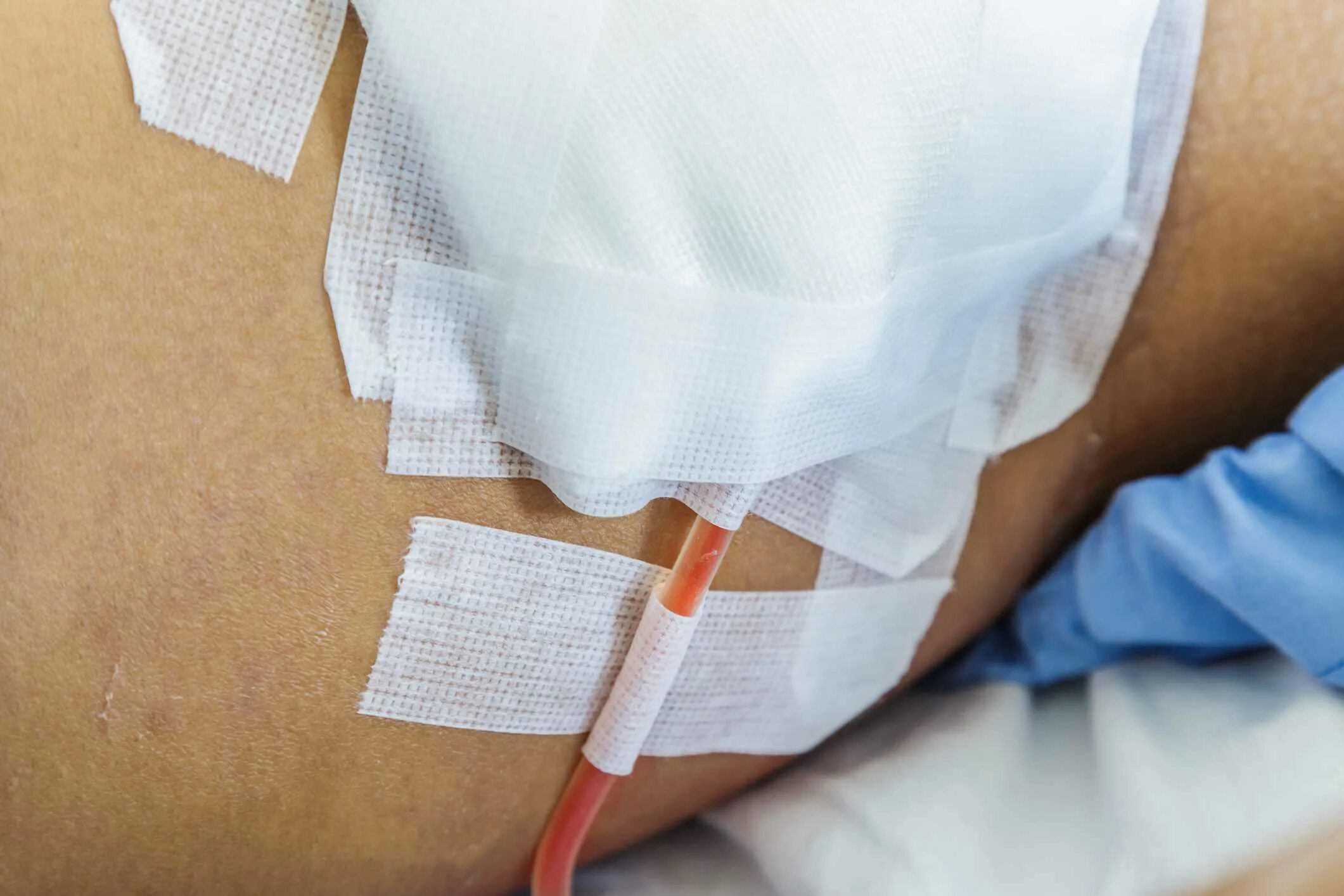 Дренажный катетер нефростома. Дренаж бюлау. Дренажная трубка в медицине. Послеоперационный дренаж. Вакуумная система для дренирования ран.