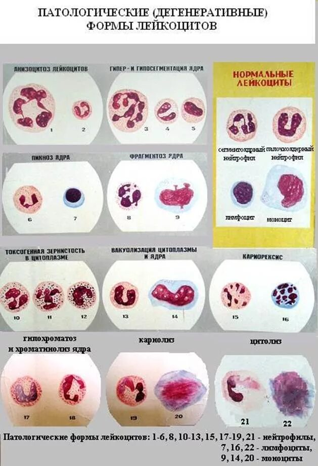 Патология лейкоцитов. Патологические дегенеративные формы лейкоцитов. Форма ядра нейтрофилы лейкоцитов. Форму патологии клеток системы крови. Морфология лейкоцитарной формулы при патологии.