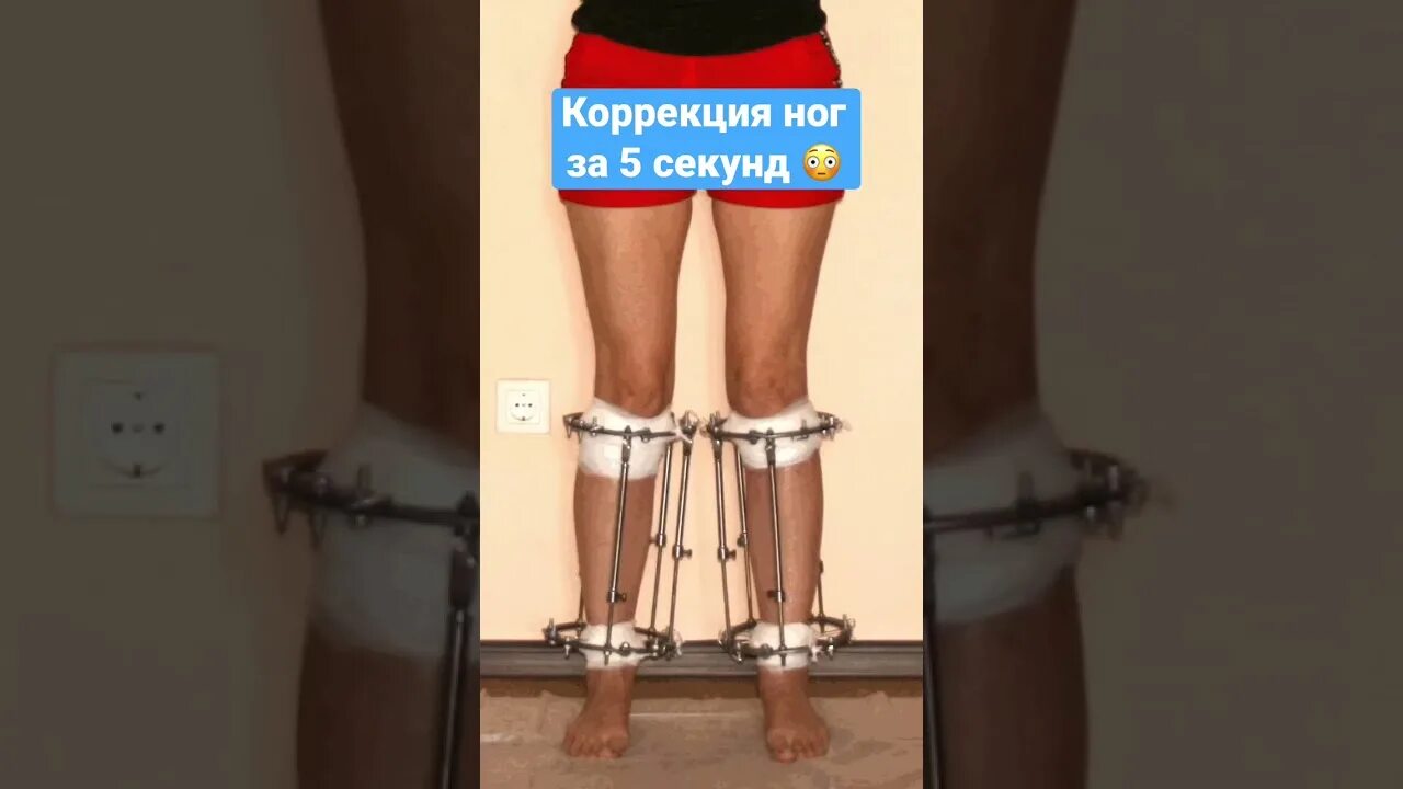 Коррекция деформаций стопы. Коррекция варусной деформации ног. коррекция варусной деформации голени. варусная деформация голени. варусная деформация ног.