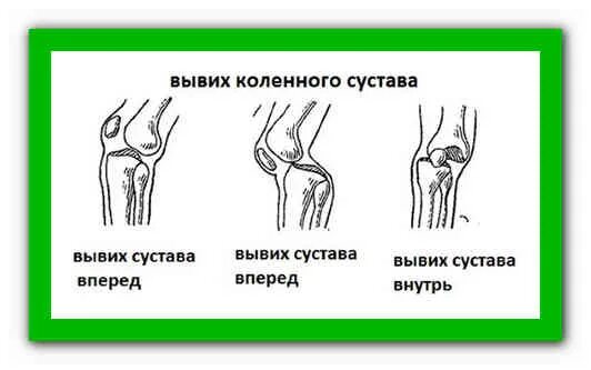 Как вправить коленную чашечку