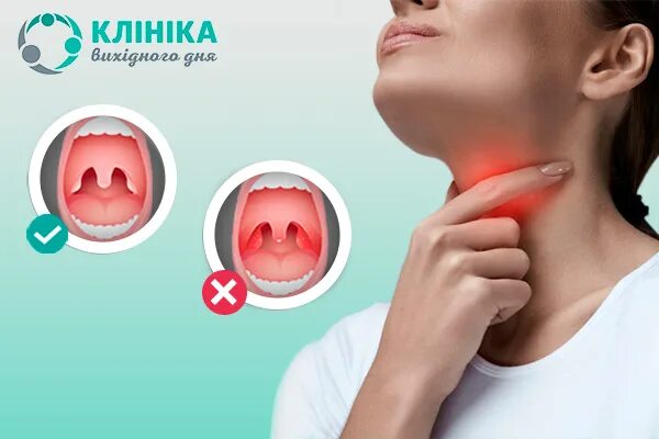 Герпетическая ангина у беременных - почему возникает и что с этим делать? О детс