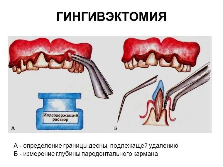Гингивотомия и гингивэктомия. Гингивопластика десневая. Гингивэктомия восьмерка. Гингивоэктомия. Гингивотомия и гингивэктомия.