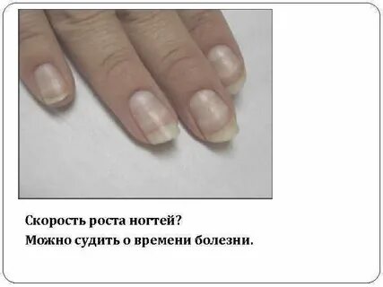 Рост ногтей на руках
