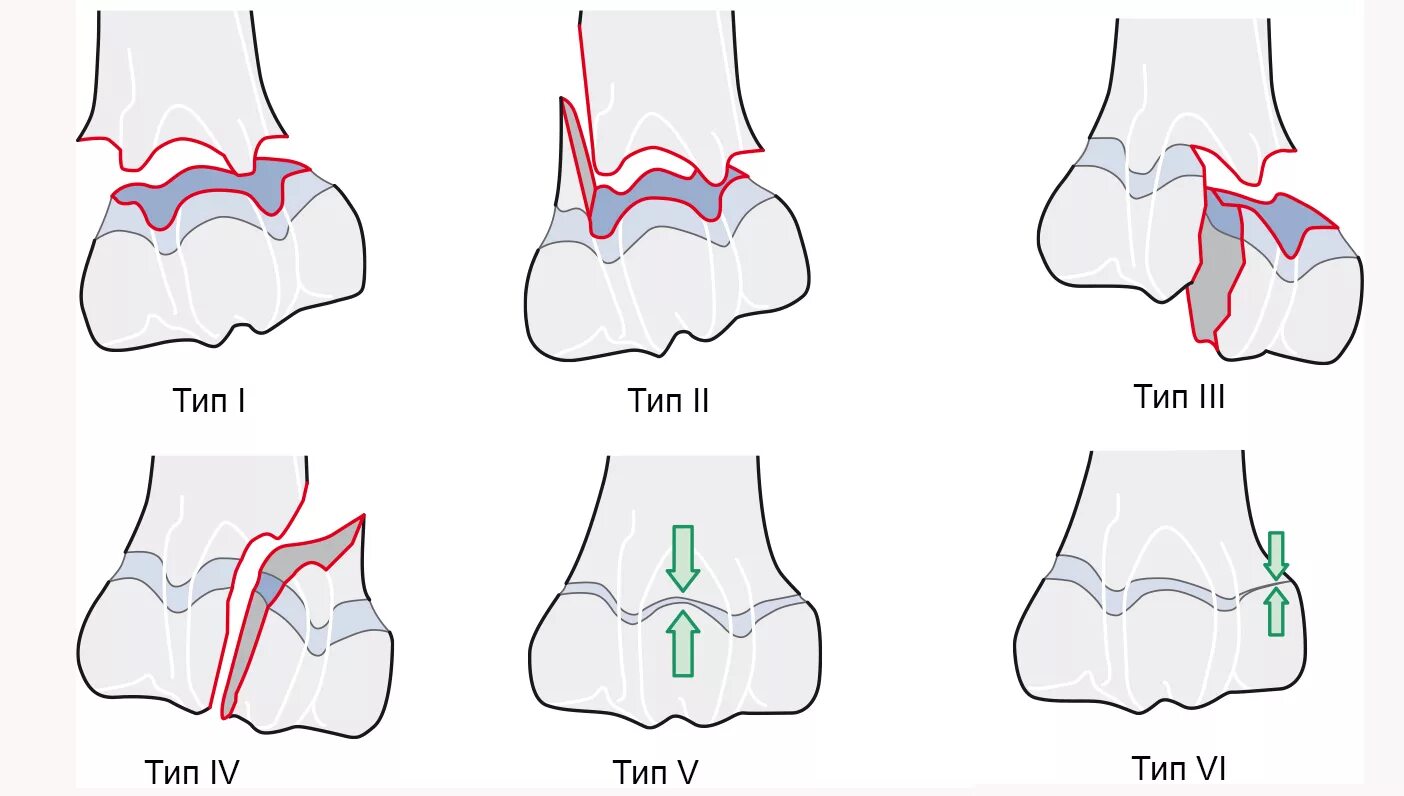 Переломы по Сальтер Харрис. Солтер Харрис классификация переломов. Перелом Salter Harris классификация.