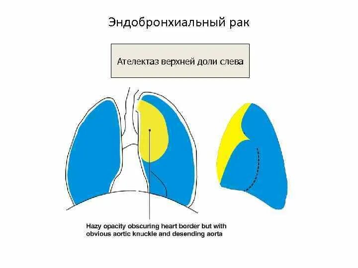 Ателектаз верхней доли слева. Ателектаз переднего сегмента верхней доли. Схемы ателектазов долей легких. Ателектаз 3 сегмента верхней доли правого легкого. Ателектаз левой доли легкого