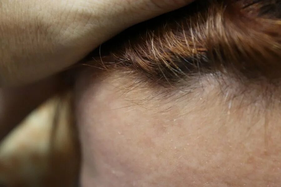 Линия роста волос. Выпадение волос до и после. Усиленное выпадение волос от алераны. Алерана витамины для волос фото до и после. Растет подшерсток на голове.