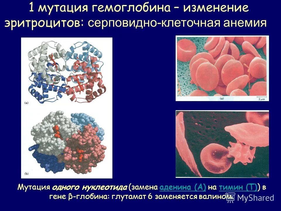 Ген серповидноклеточной анемии. Серповидно клеточная анемия эритроциты. Серповидно-клеточная анемия (s-гемоглобинопатия). Серповидноклеточная анемия мутация. Мутации гемоглобина.