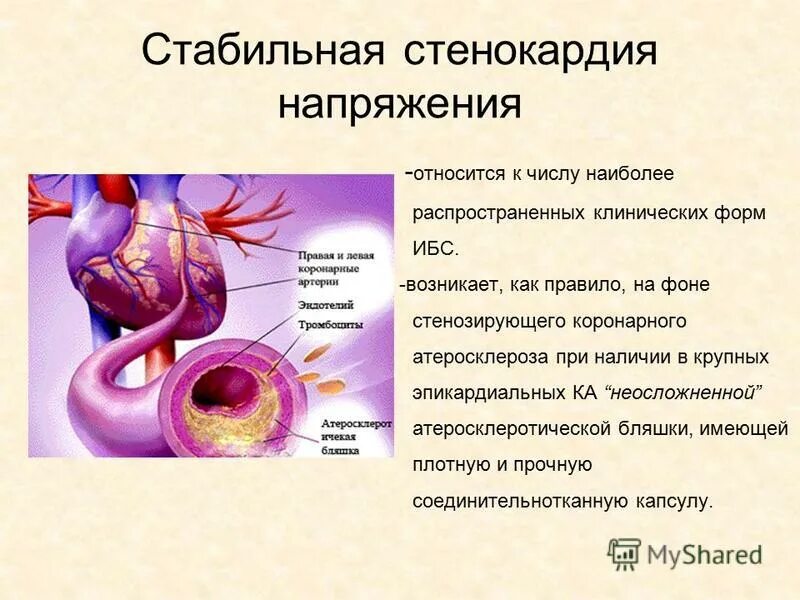 Стенозирующий атеросклероз мкб 10. Стенозирующий атеросклероз мкб 10