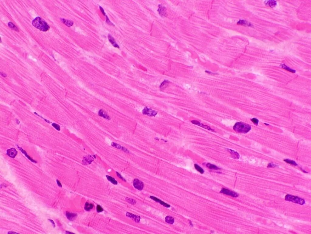 Сердечная ткань миокарда. Межуточный миокардит гистология. гигантоклеточный миокардит гистология. миокард микропрепарат гистология. клетки миокарда гистология.