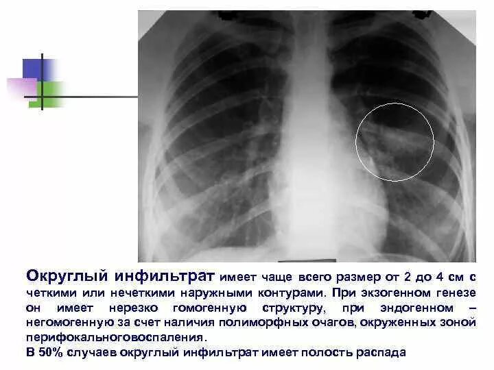 Множественные очаги в легких рентген. Инфильтративный туберкулёз s1-2 левого. Инфильтративный туберкулез рентгенограмма. Казеозная пневмония туберкулез. Инфильтративный туберкулез рентген.